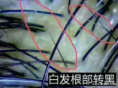 簽約治療，無效全額退款。白發(fā)轉(zhuǎn)黑發(fā)，生發(fā)，長出來的就是黑頭發(fā)